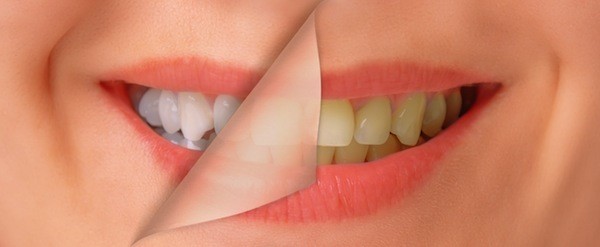 Teeth whitening