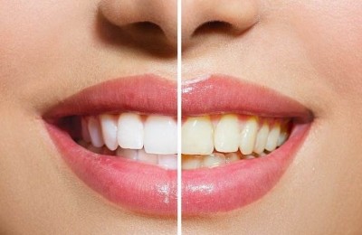 Teeth whitening 1