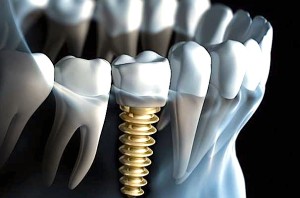 dental implant